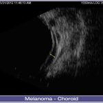 01-Melanoma-Choroid-001-lg-1024x686