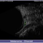 01-Melanoma-Choroid-002-lg-1024x686