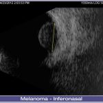 02-Melanoma-Inferonasal