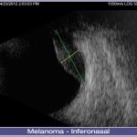 02-Melanoma-Inferonasal