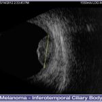 03-Melanoma-Inferotemporal-Ciliary-Body-001-lg-1024x686