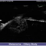 04-Melanoma-Ciliary-Body