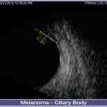 04-Melanoma-Ciliary-Body