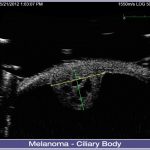 04-Melanoma-Ciliary-Body