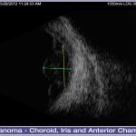 05-Melanoma-Choroid-Iris-and-Anterior-Chamber