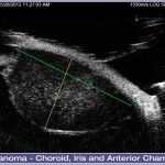 05-Melanoma-Choroid