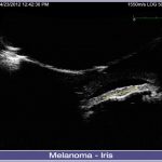 06-Melanoma-Iris