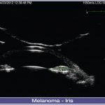 06-Melanoma-Iris