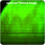 optos 200Dx -Eye closed