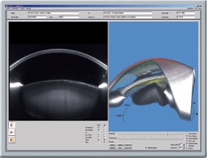 Pentacam - Tomography