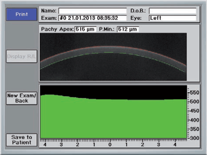 corneal-thickness-profile-over-the-horizontal-sectional
