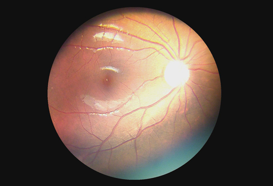 Horus Digital Fundus Camera_DEC 100 - through the scope