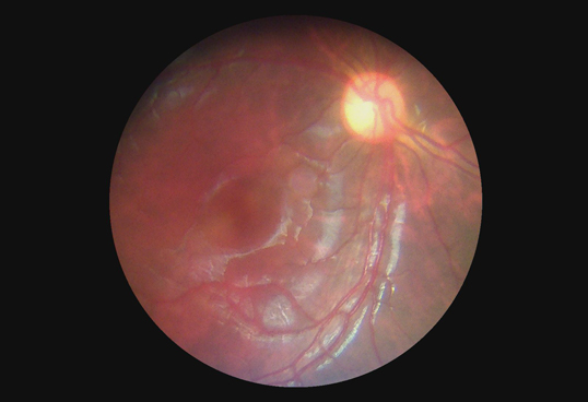 Horus Digital Fundus Camera_DEC 100 - through the scope