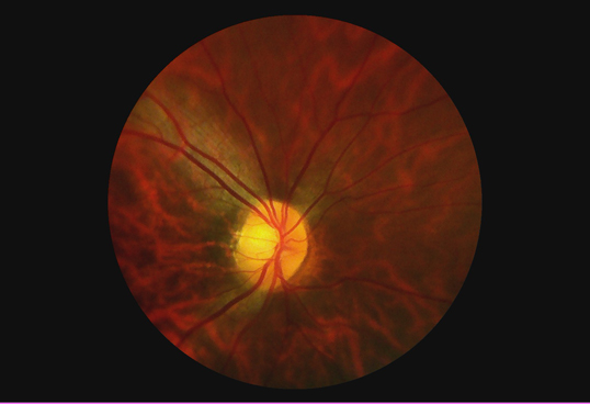 Horus Digital Fundus Camera_DEC 100 - through the scope