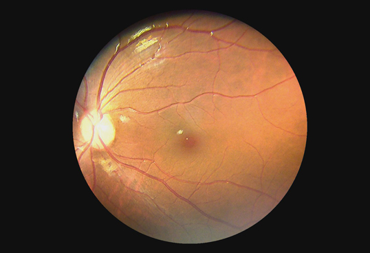 Horus Digital Fundus Camera_DEC 100 - through the scope